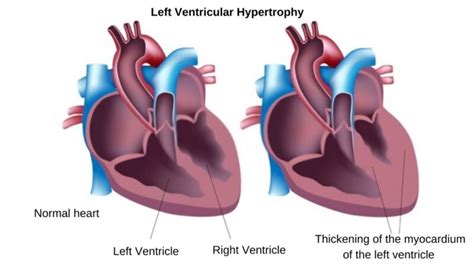 causes of lv hypertrophy|left ventricular hypertrophy nice guidelines.